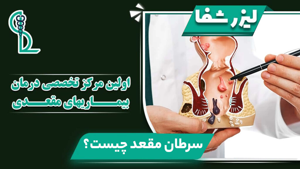 بنر آموزشی کلینیک لیزر شفا با عنوان سرطان مقعد چیست همراه با ماکت آناتومی پزشکی