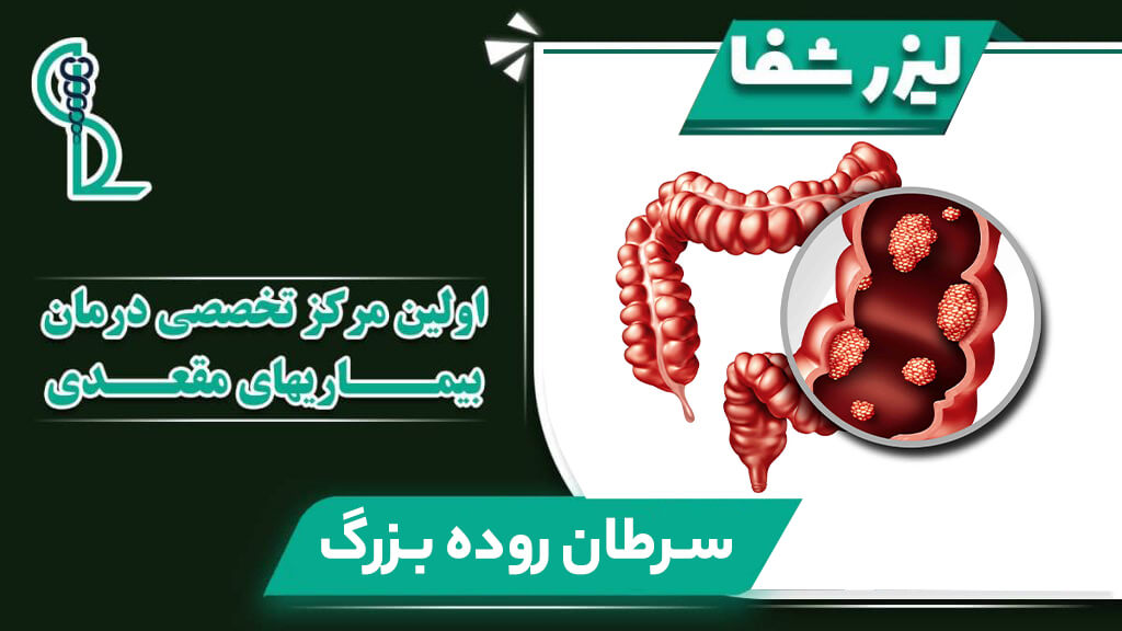 مایش شماتیک تومور در روده بزرگ و رکتوم برای تشخیص سرطان کولورکتال