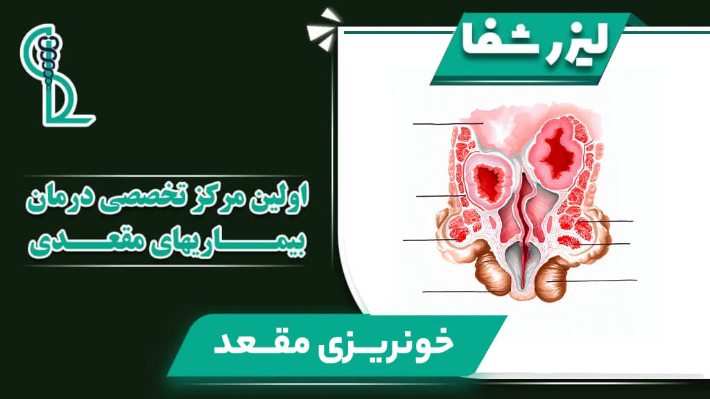 علت خونریزی مقعدی و روشهای درمان آن در اولین مرکز تخصصی لیزر بیماریهای مقعدی
